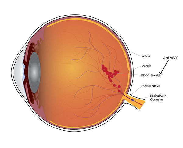 Retinal Vein Occlusion