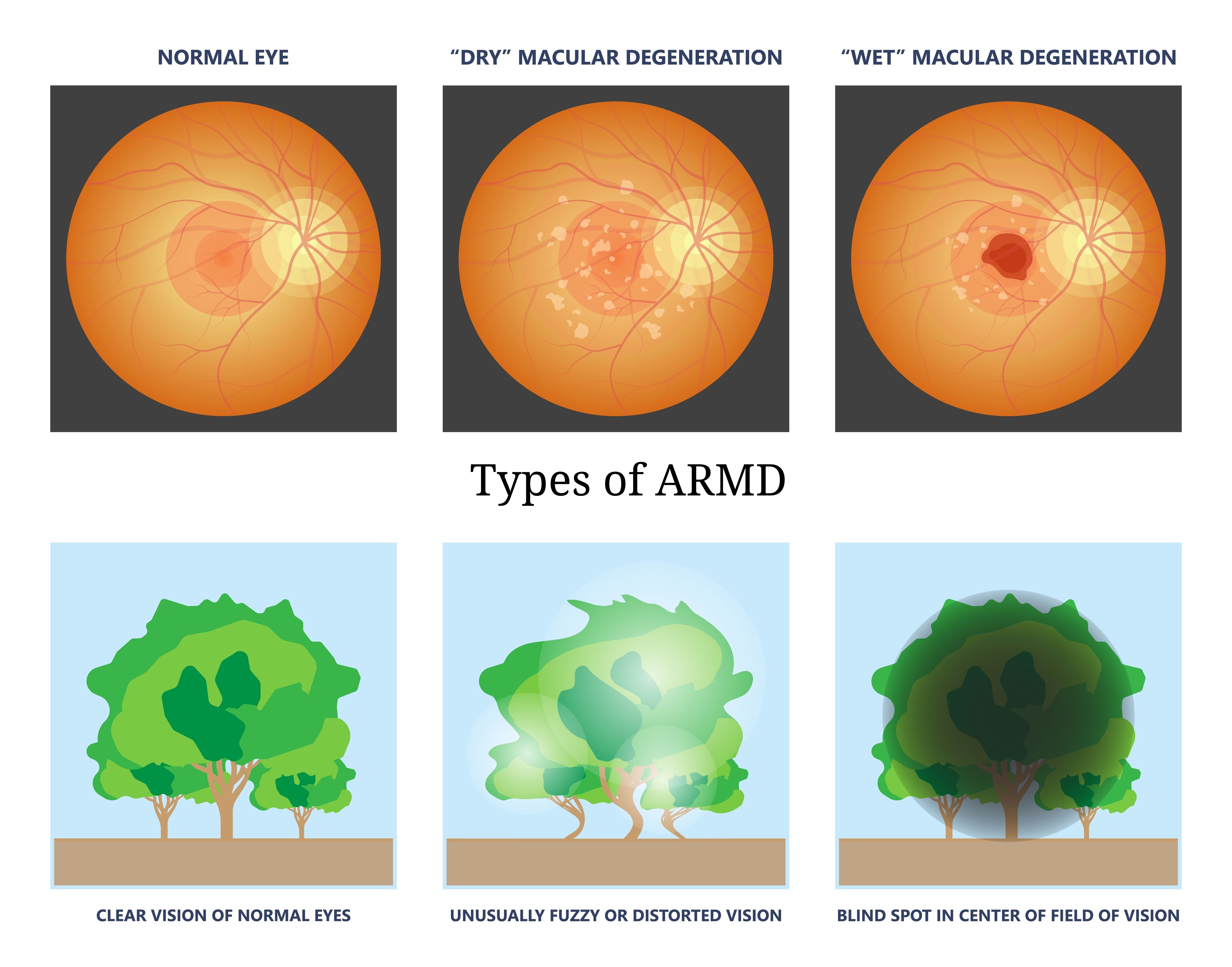 ARMD – Goyal Eye