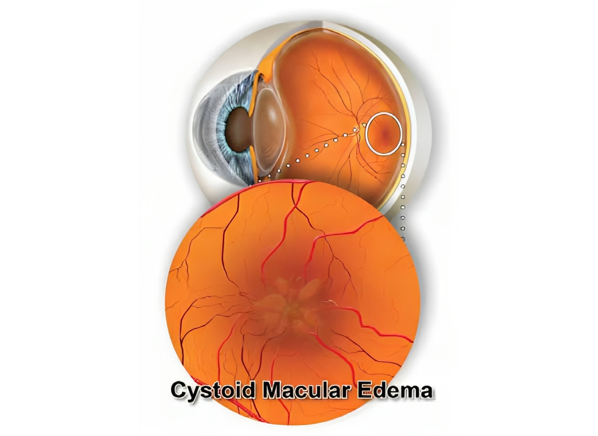 Cystoid Macular Edema (CME) Symptoms, Causes, Tests, & Treatments