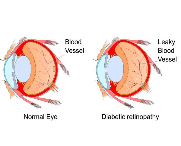 Diabetic Retinopathy – Goyal Eye