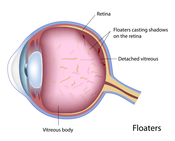What are Floaters
