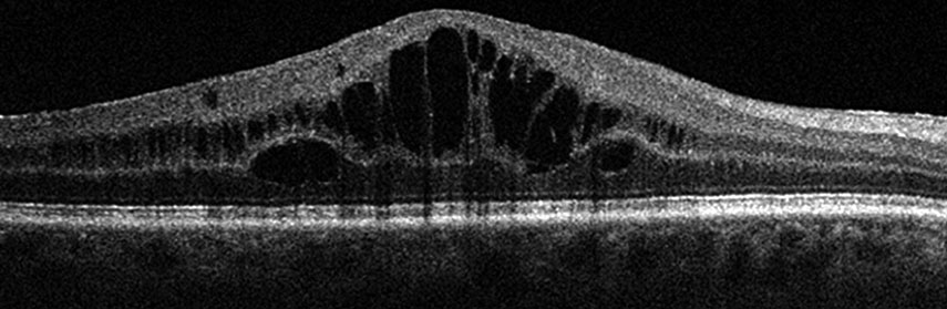 Macular Edema Retina Condition