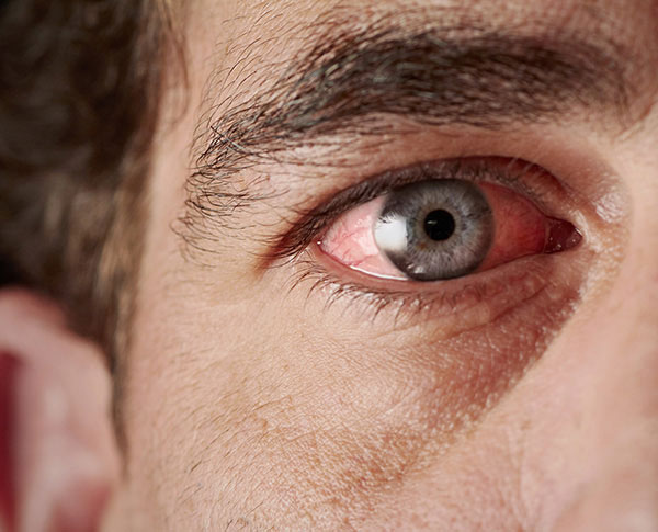 Causes of Red Eyes
