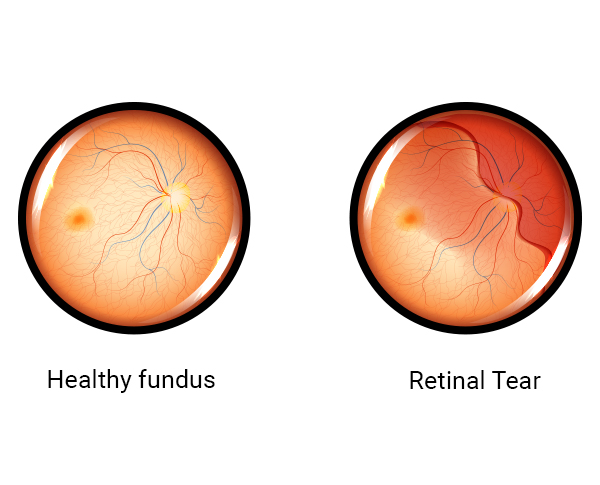 Healthy Eye v/s Retinal Tear